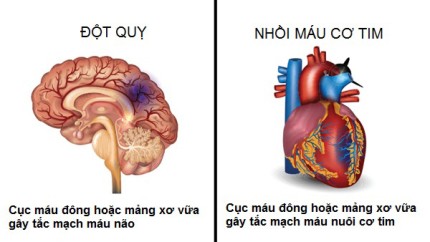 Nhồi máu cơ tim và đột quỵ đều là tình trạng bệnh lý liên quan đến sự ngưng lưu thông máu.